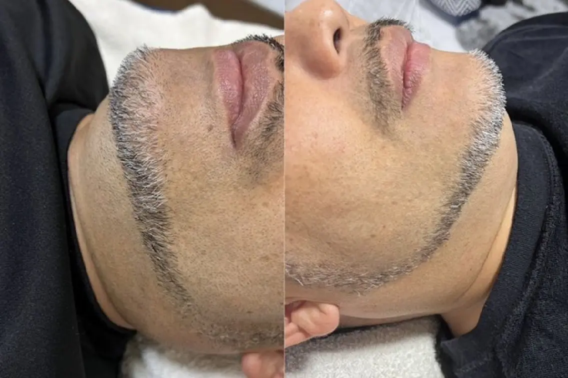 【メンズ】首＋顎下 脱毛の写真