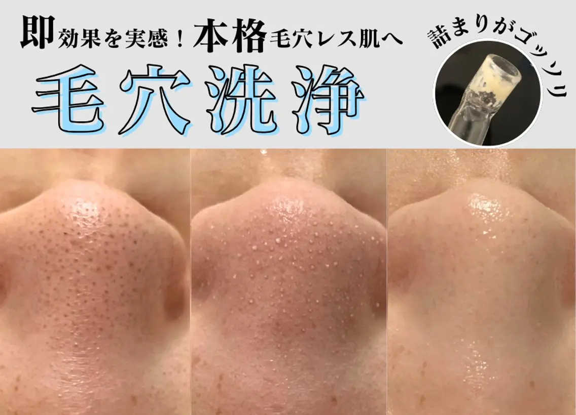 【30・31日1名様限定】即日効果✨全顔毛穴洗浄×肌質別美容液×毛穴レスパックで陶器肌へ!【黒ずみ・詰まり毛穴に】の写真