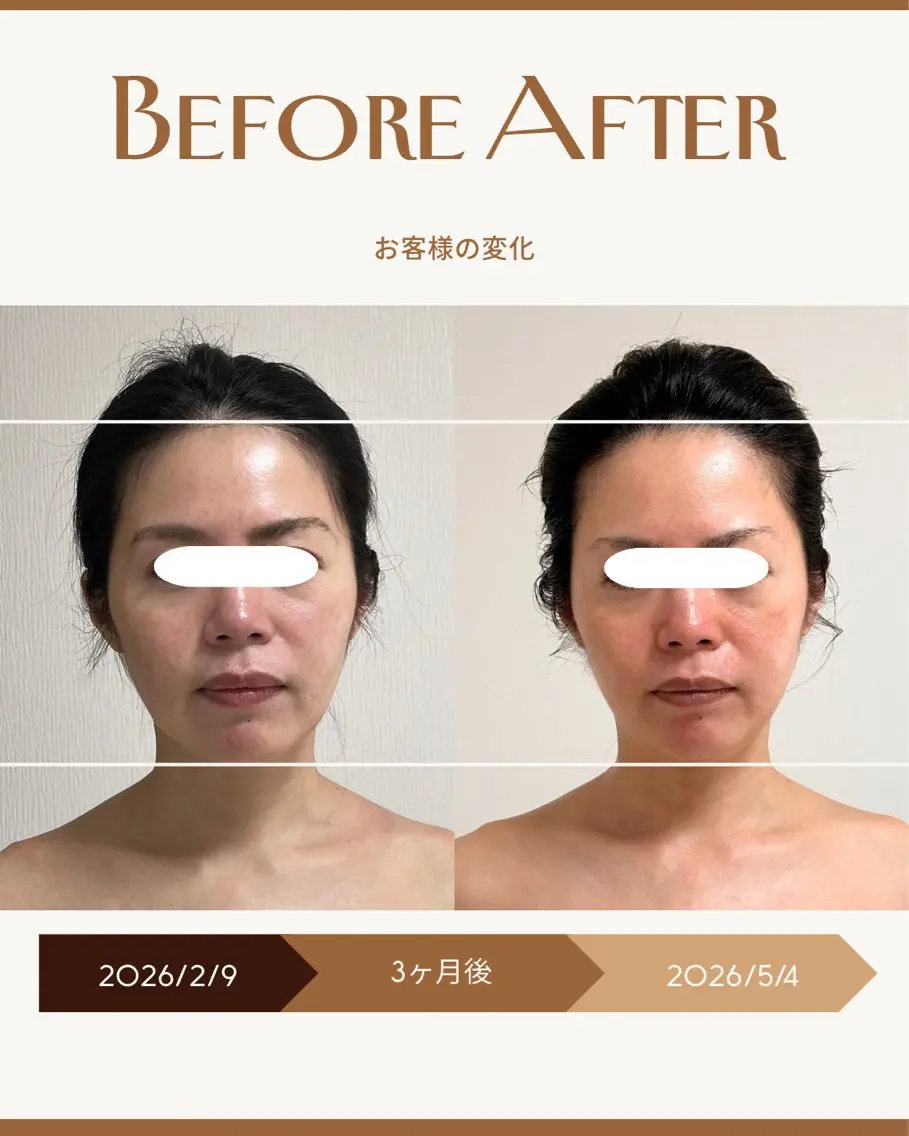 🌿 3ヶ月間(6回来店条件)90分【フェイスラインすっきり小顔ヘッドスパ】の写真