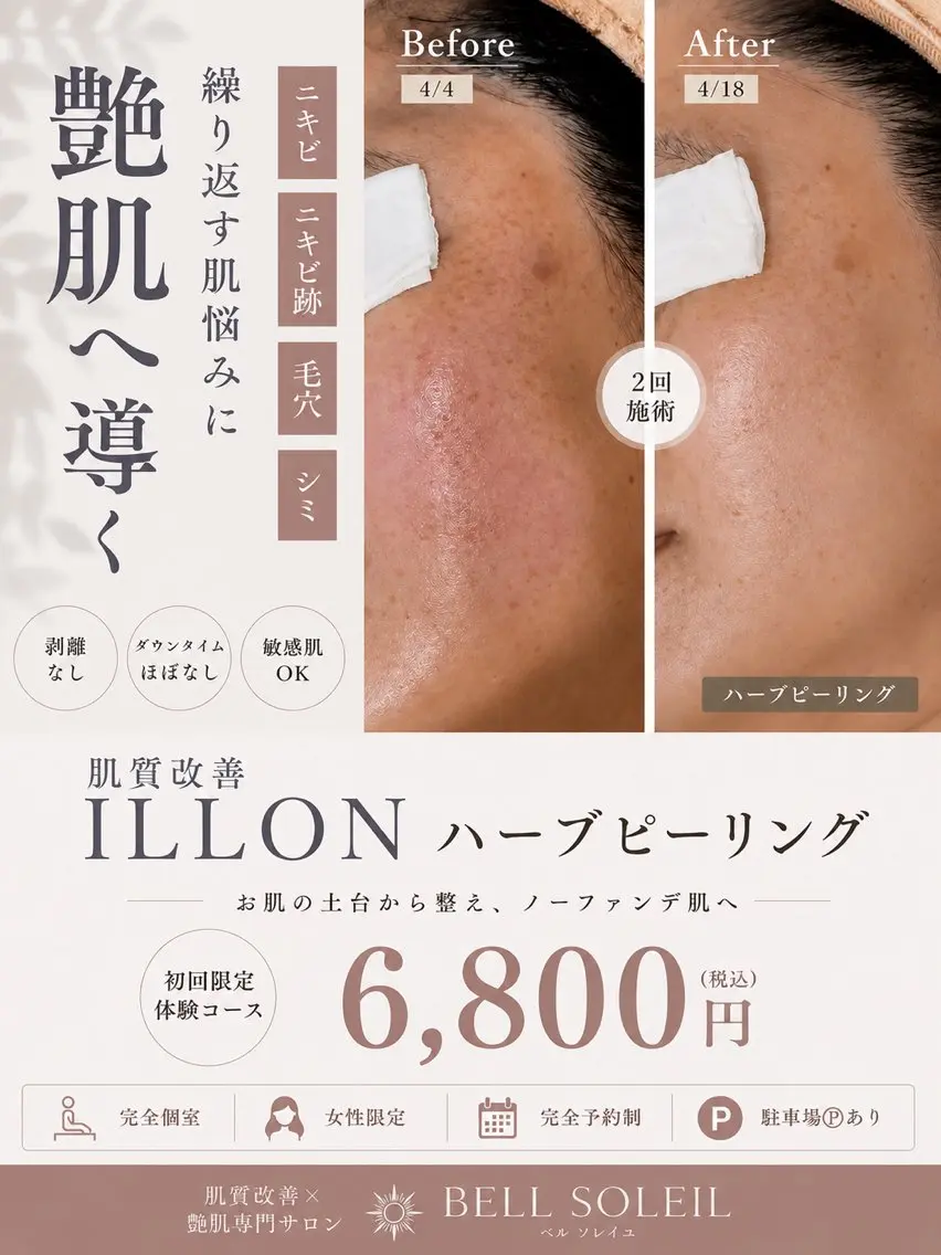 【ILLON】⭐︎韓国肌質改善⭐︎ハーブピーリング🌿初回6800円の写真