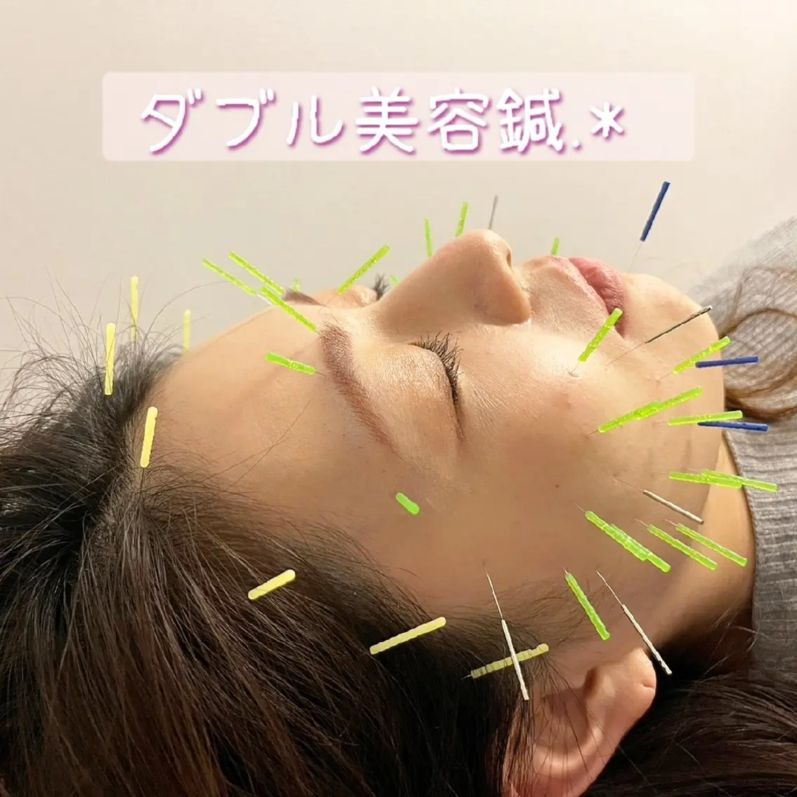 🌼ダブル美容鍼🌼50本✨の写真
