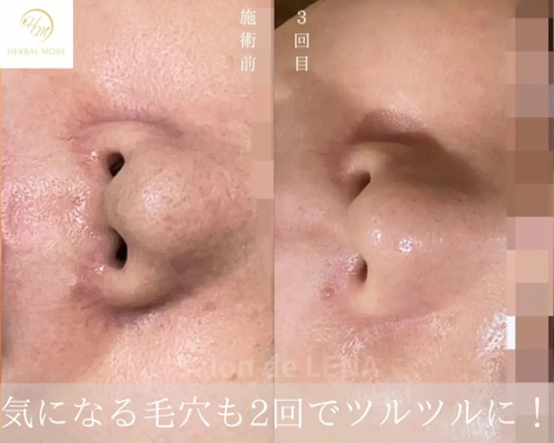 【顔◆最強毛穴ケア】ハーブピーリング×毛穴洗浄×角栓ケア×鎮静の写真