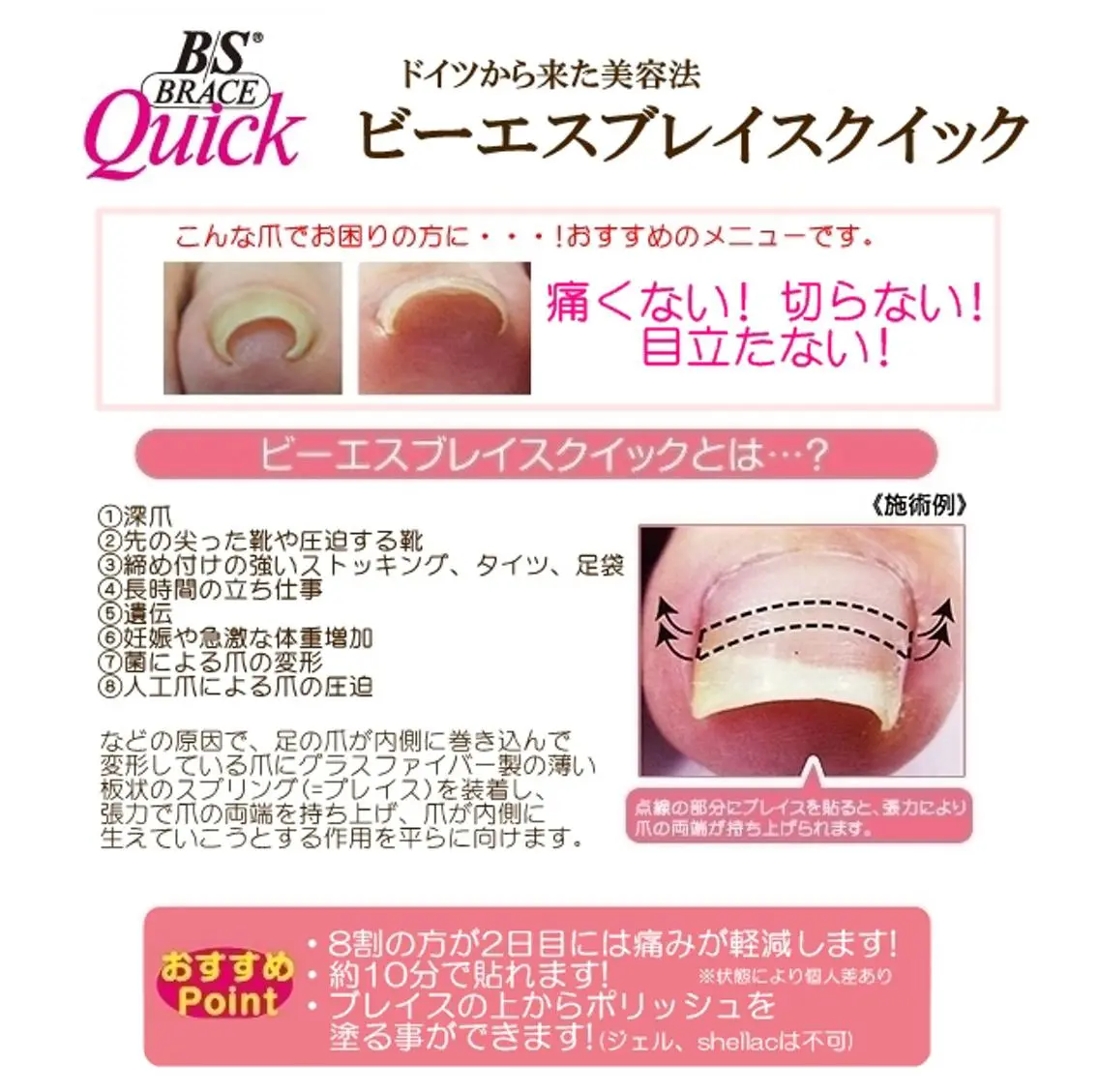 【巻き爪矯正】B/Sブレイス🍀1本5600円の写真
