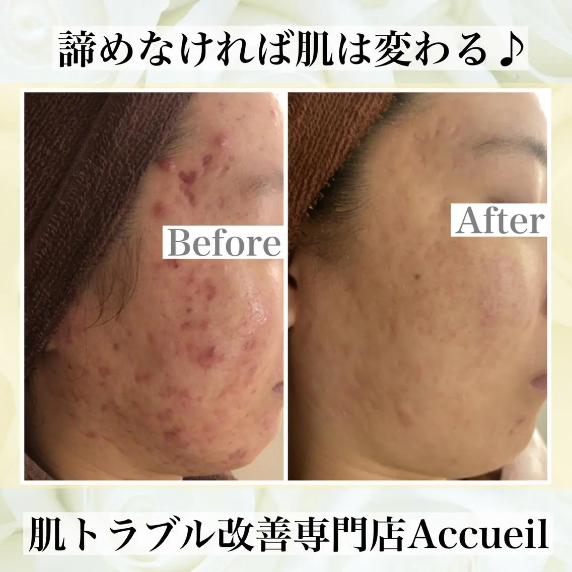 ミディアム カラー パーマ ヘアアレンジ メンズ キッズ ネイル マツエク・マツパ エステ リラク ニキビ・肌質改善専門 ♡人生が変わるサロンのエステ・リラクイメージ