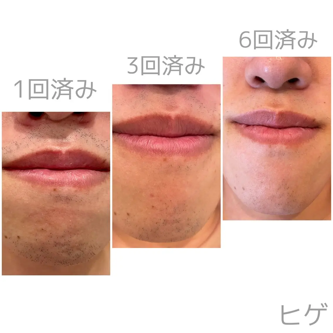 【ミニモ限定🌟メンズ👱‍♂️】　《ヒゲ脱毛》　毎日の自己処理を楽にしませんか？ヒゲ脱毛でカミソリ負けから解放‼️の写真