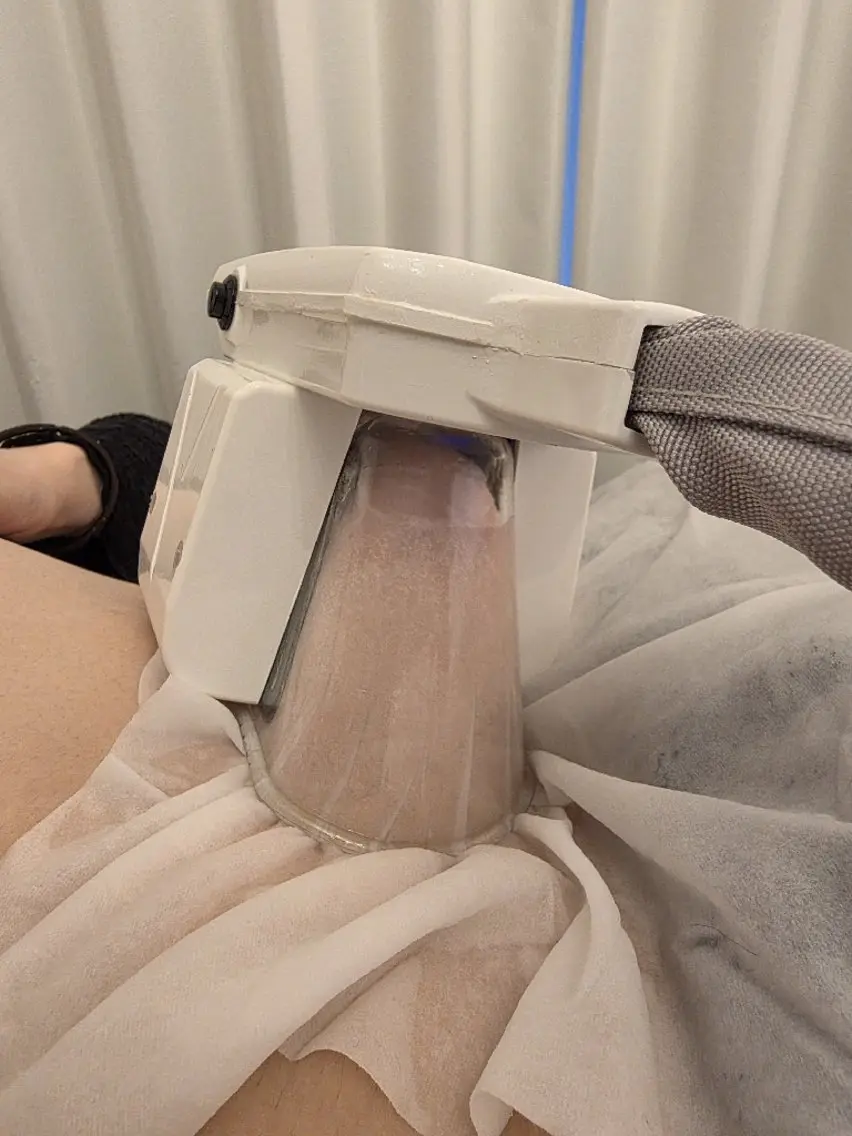 キャビクライオⅡ 脂肪 冷却 吸引 2カップの写真