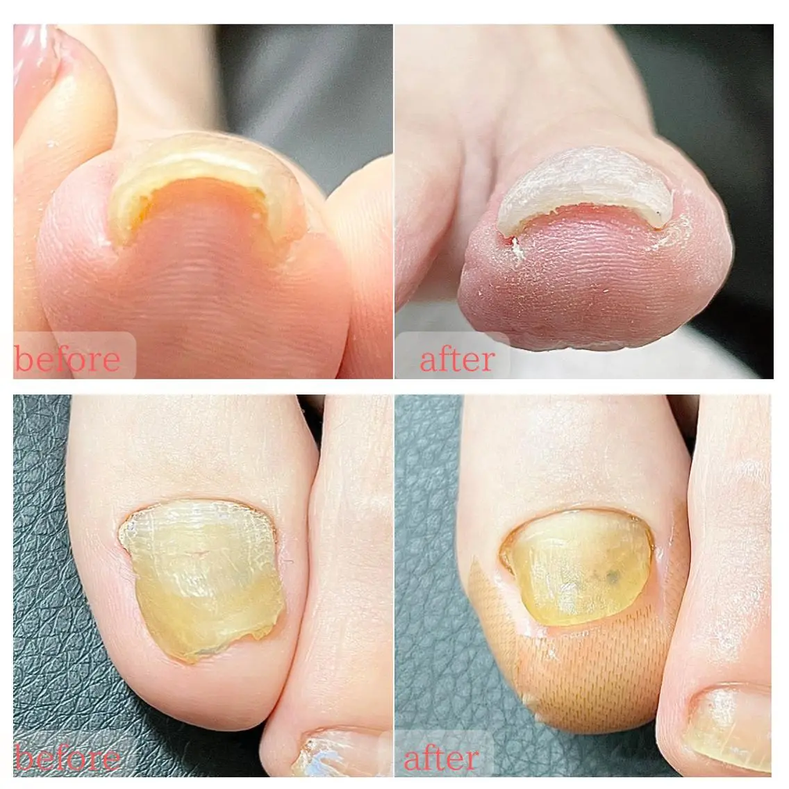 ネイル 深爪・巻き爪 専門サンセリテのネイルデザイン