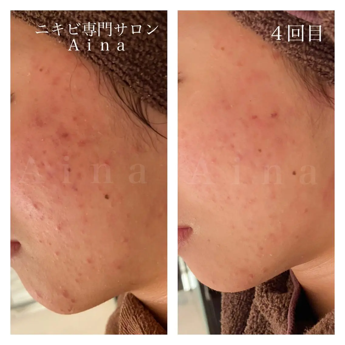 セミロング パーマ ヘアアレンジ メンズ キッズ ネイル マツエク・マツパ 赤色 エステ リラク ニキビ跡専門サロン Ａｉｎａのエステ・リラクイメージ