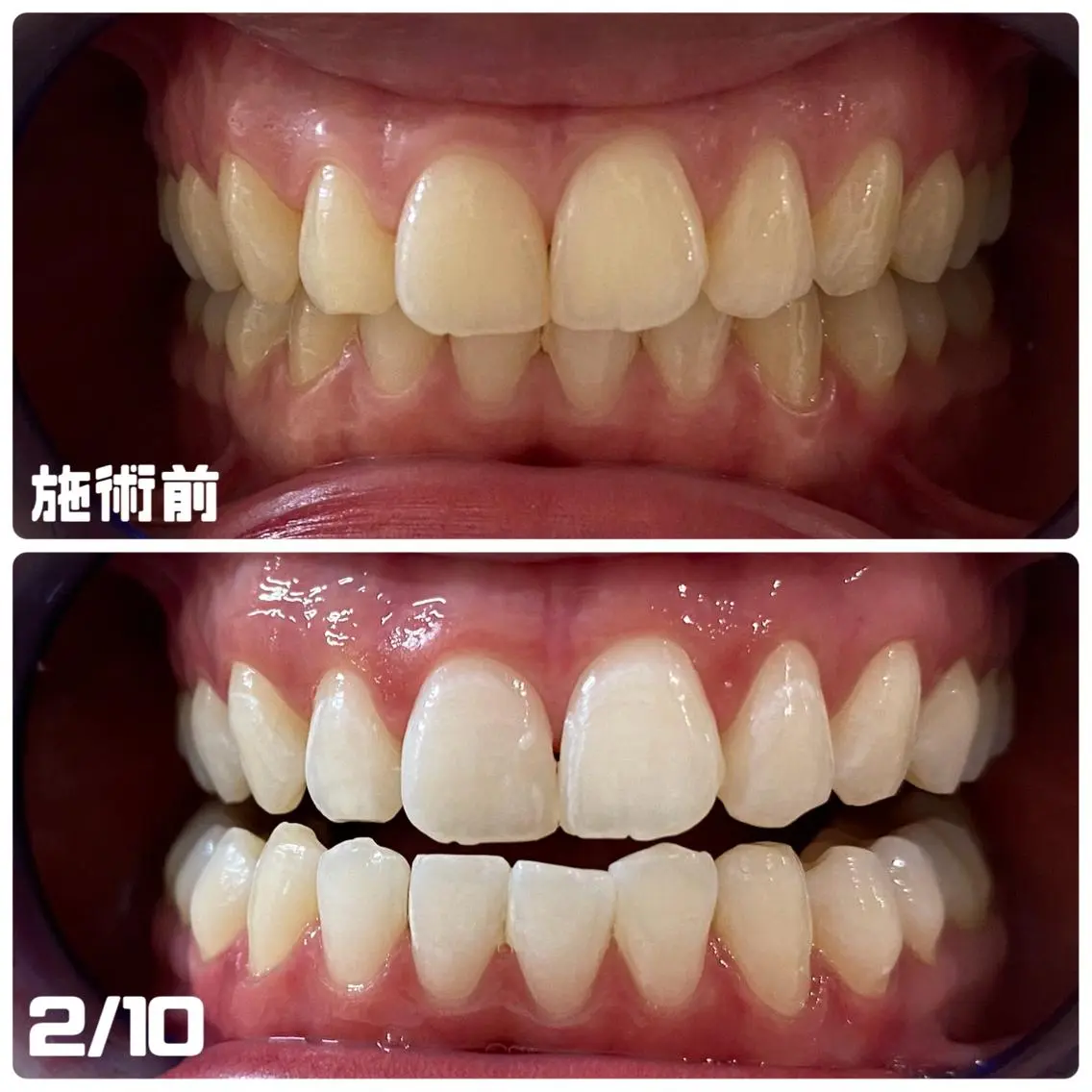 セルフホワイトニング 🦷口元垢抜け✨のその他イメージ