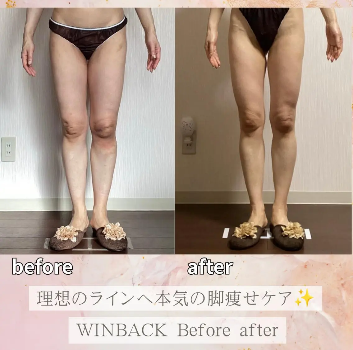 【人気No.1】冷え、ハミ肉、ポッコリお腹/痩身!ラジオ波WINBACK×最強リンパ(上半身or下半身)90分の写真