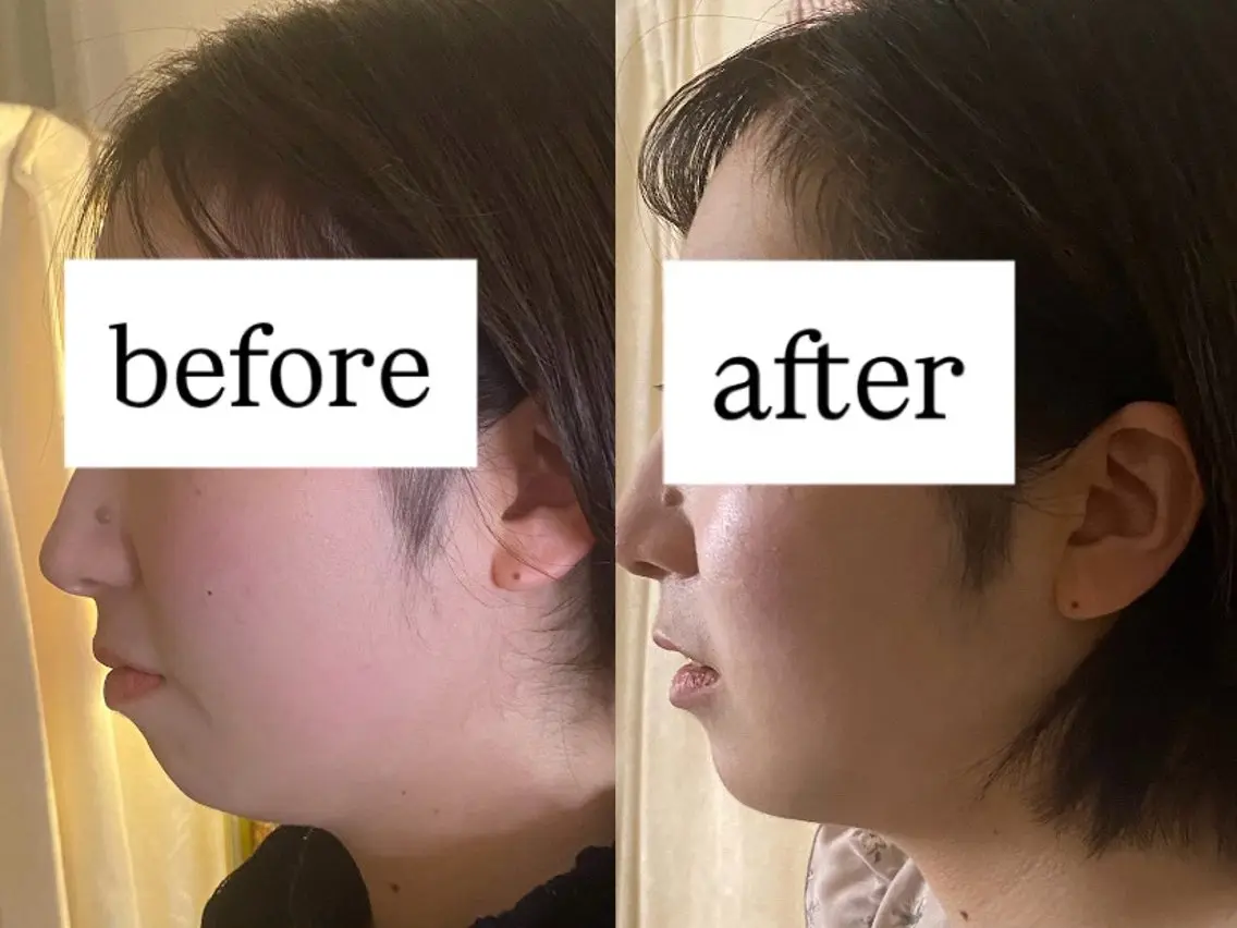 まずはお試し🍀【美容鍼】小顔/むくみ/たるみ/眼精疲労/脳疲労の写真