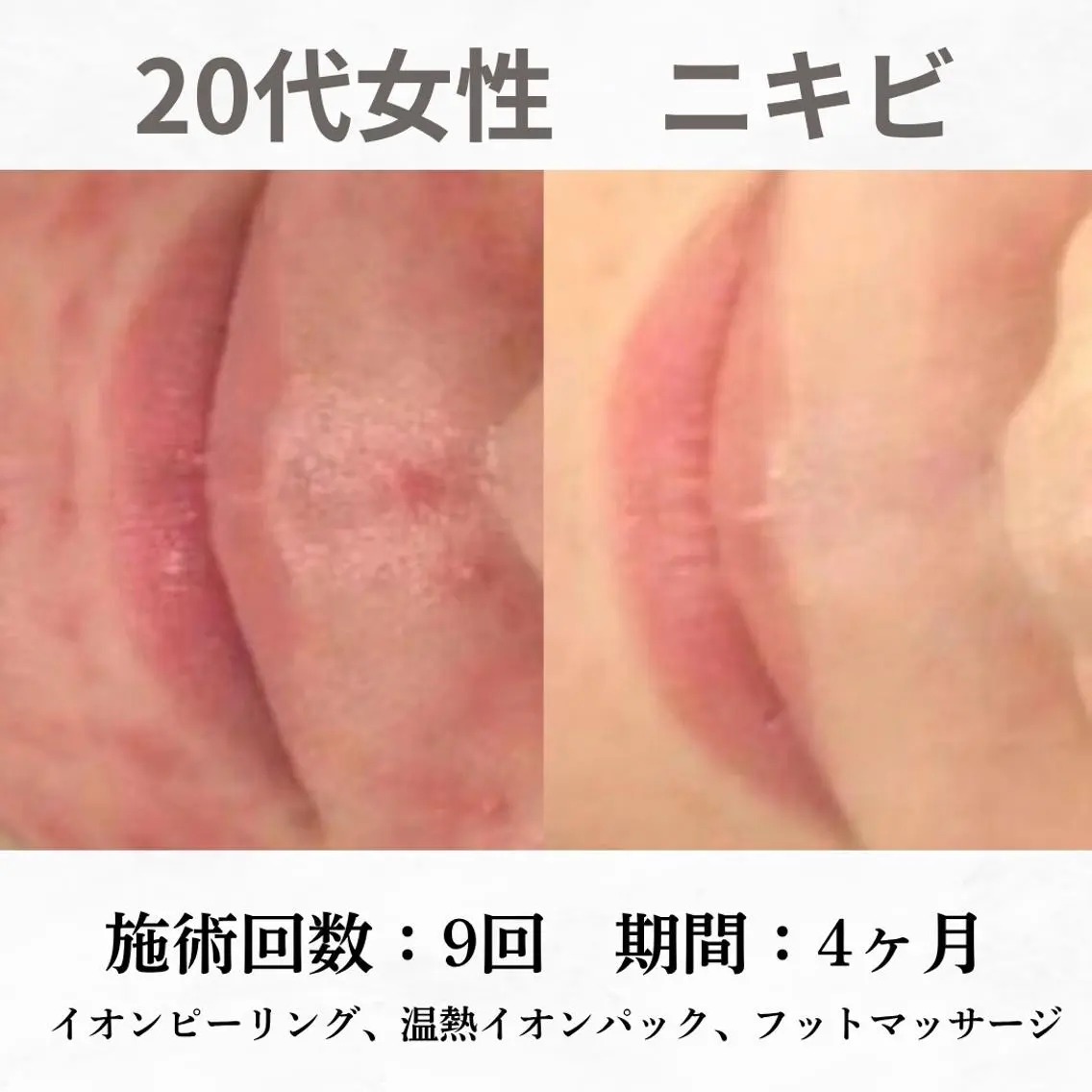 重度ニキビ専門🌼 ダウンタイムなしのエステ・リラクイメージ