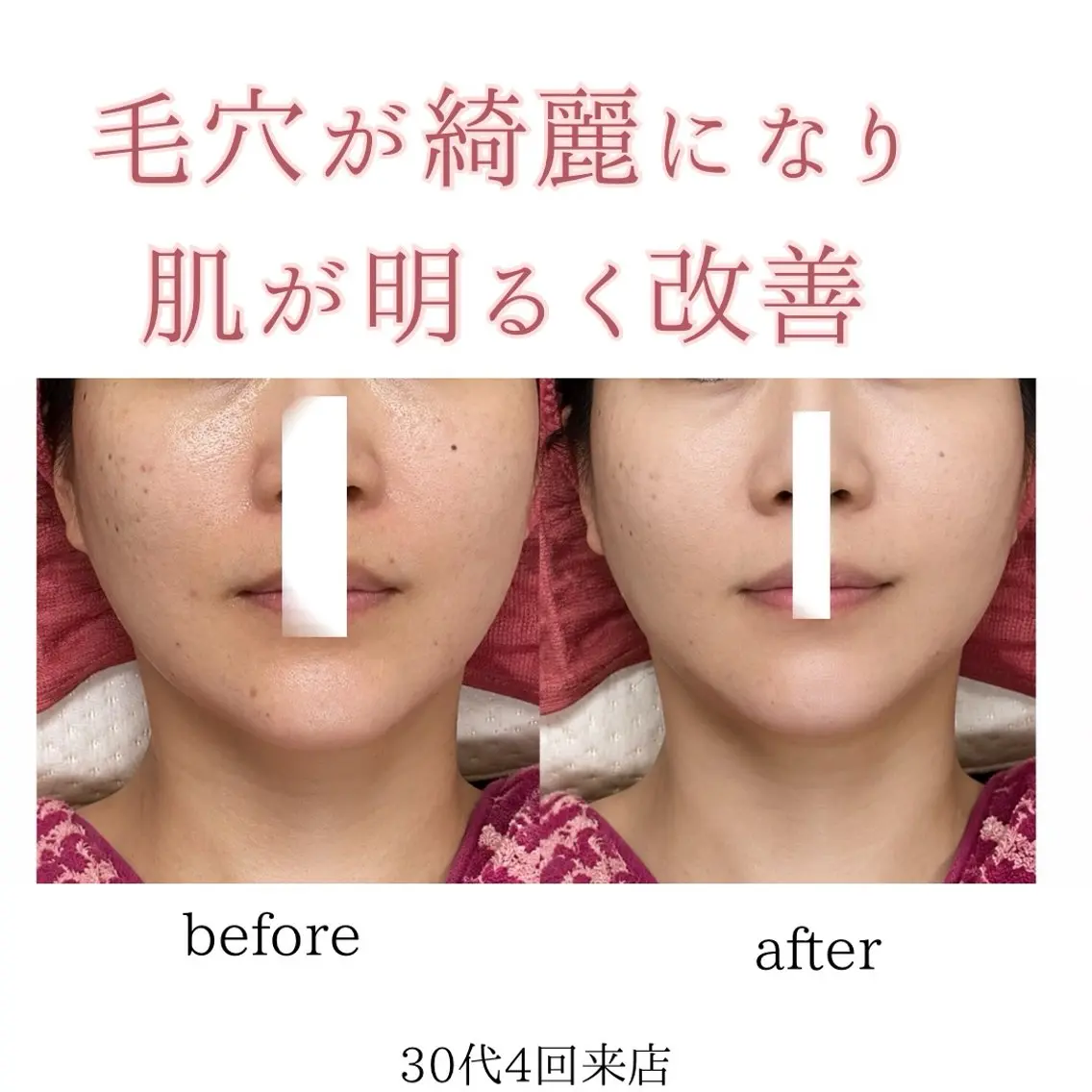 シミニキビ改善 小顔脱毛サロンのエステ・リラクイメージ