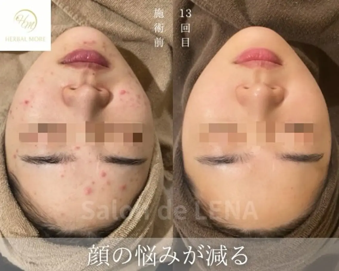 【Xmasイベント】剥けない艶肌ハーブピーリング《顔用》の写真