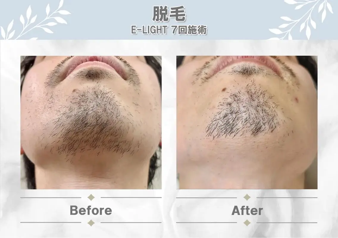 🥸メンズ脱毛ひげ全体🥸の写真