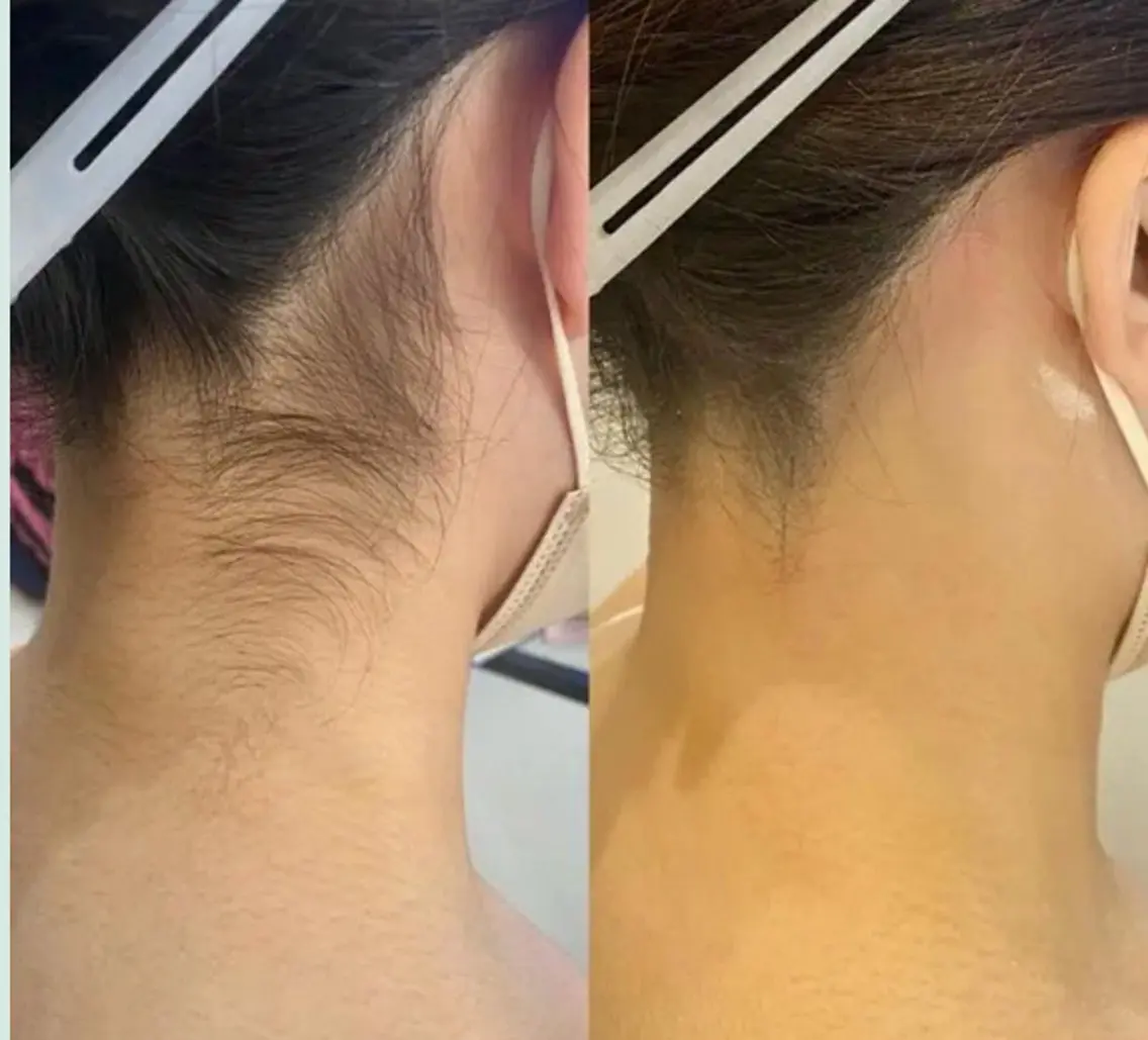 後ろ姿に自信が持てる えり足脱毛の写真