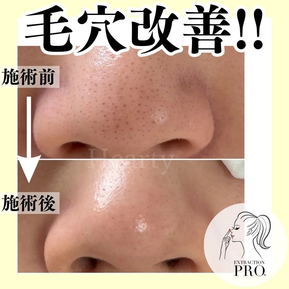 ❤️minimo価格\\即実感//結果重視!!毛穴エクストラクションプロ/フェイシャルエステ💆🏻‍♀️の写真