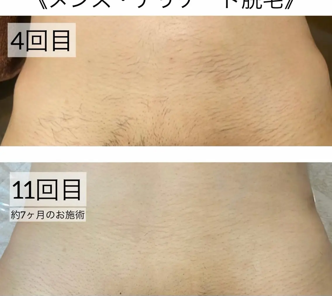 脱毛 Folche 春日 用松🦋🫧のエステ・リラクイメージ