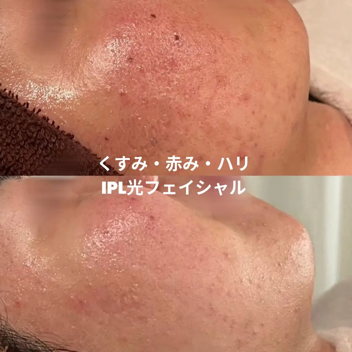 【初回】IPL光フェイシャル✨くすみ・赤み・ハリ感upの写真