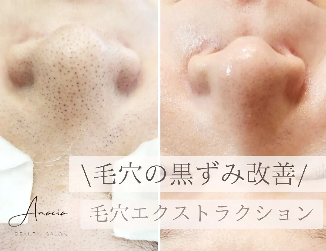 脱毛 美肌脱毛&毛穴専門 Anaciaのエステ・リラクイメージ