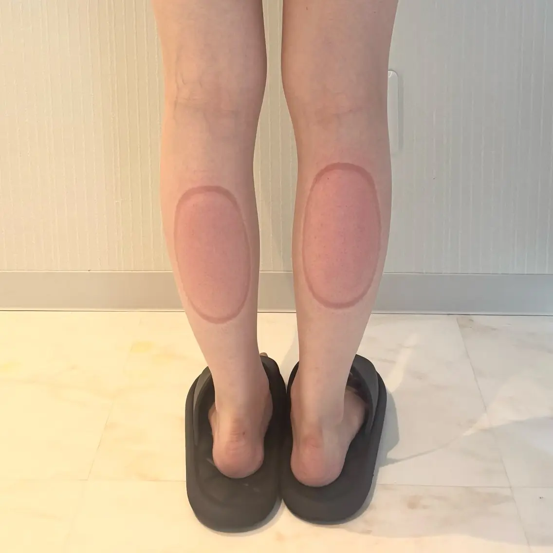 脂肪痩身〈ふくらはぎ〉初回体験2カップの写真