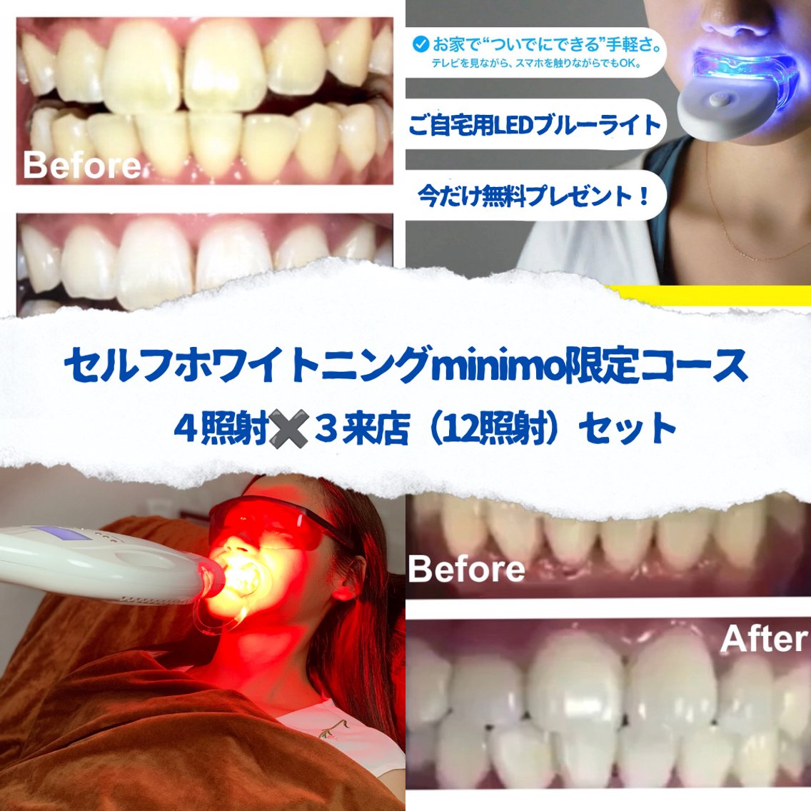 【🉐3回セット】セルフホワイトニング12照射セット(10分✖️4照射を3回)🦷今だけご自宅用LEDプレゼント🎁の写真