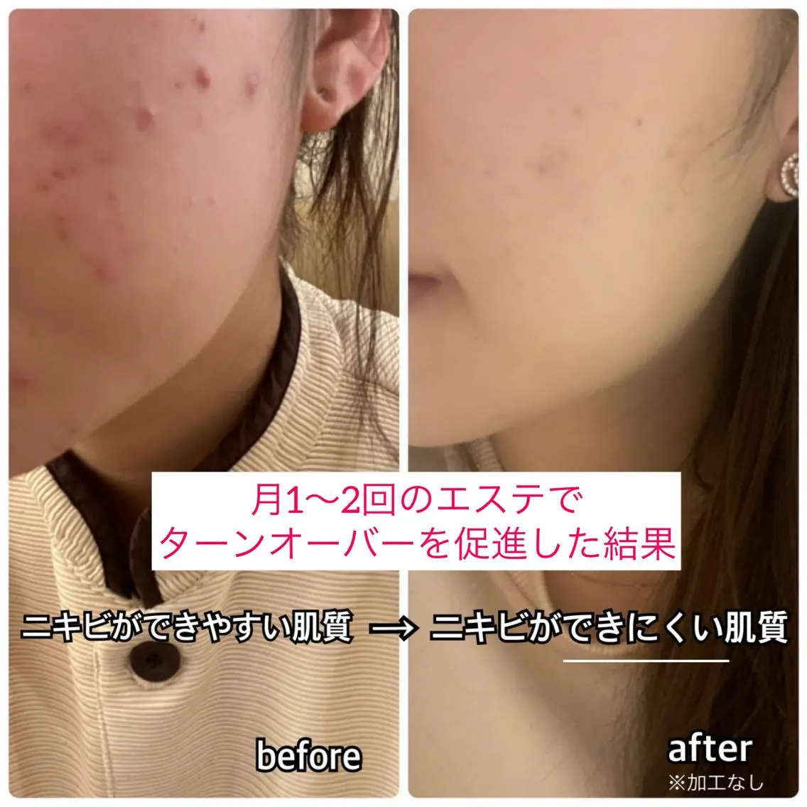 【開き毛穴・黒ずみ】ハンドクレンジング→ブラシクレンジング→毛穴洗浄/ 吸引→ 高保湿小顔マッサージ→毛穴引き締めの写真