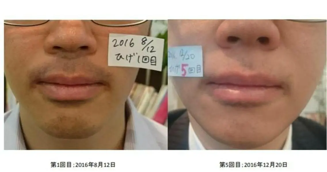 【初回★minimo男性限定】痛くない！メンズヒゲ脱毛（口周り）の写真