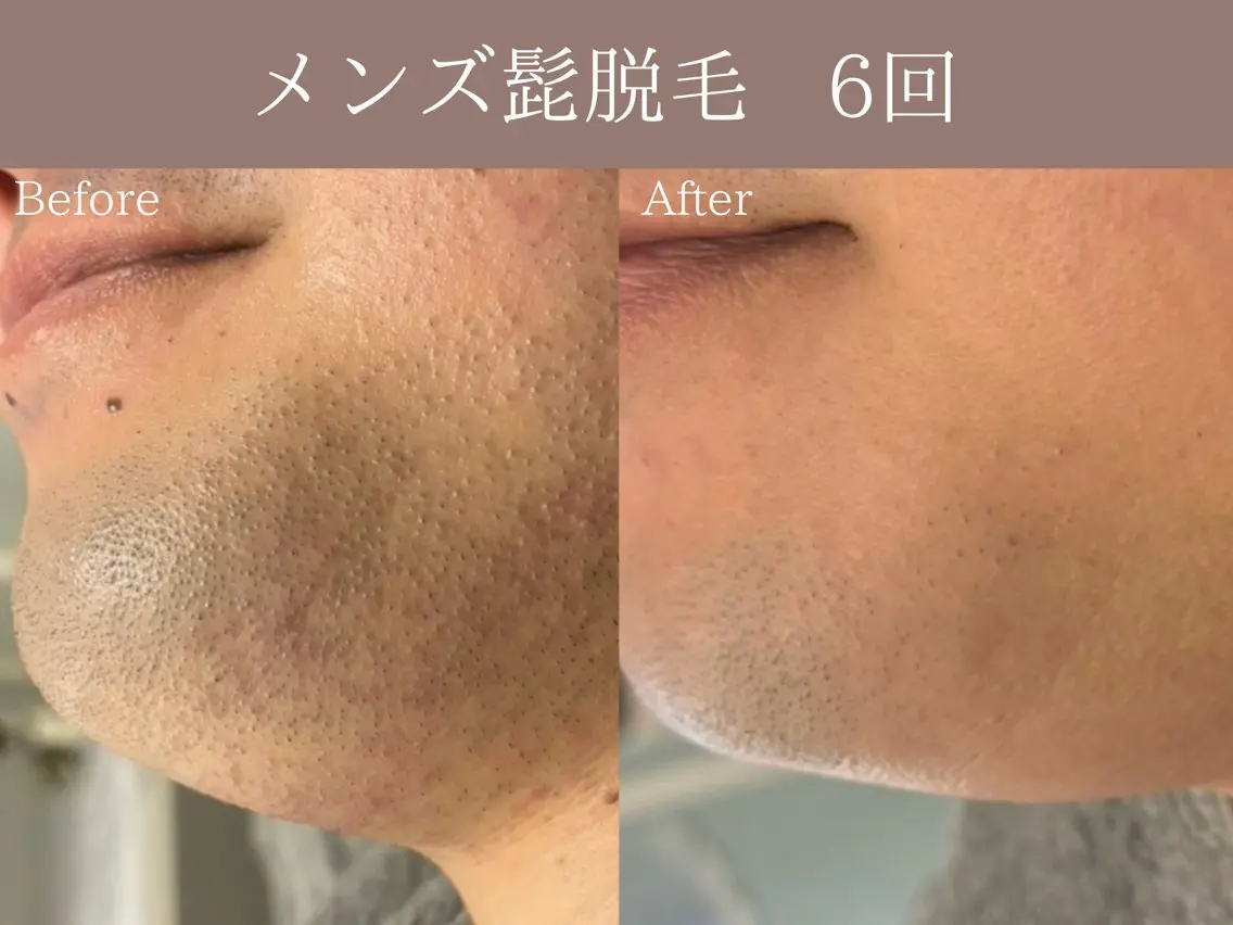 【メンズ髭脱毛】 REVI美肌脱毛の写真
