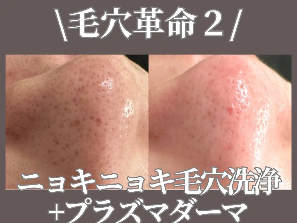 《毛穴革命》ニョキニョキ毛穴洗浄(全体)+プラズマの写真