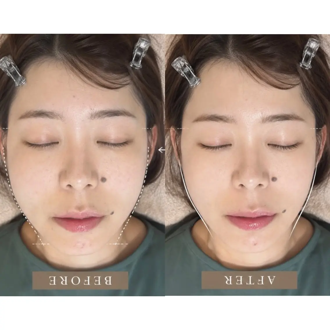 小顔美肌へ✨小顔矯正×毛穴洗浄×ヘッドスパ 【エラ/左右差/むくみ/凝り】の写真