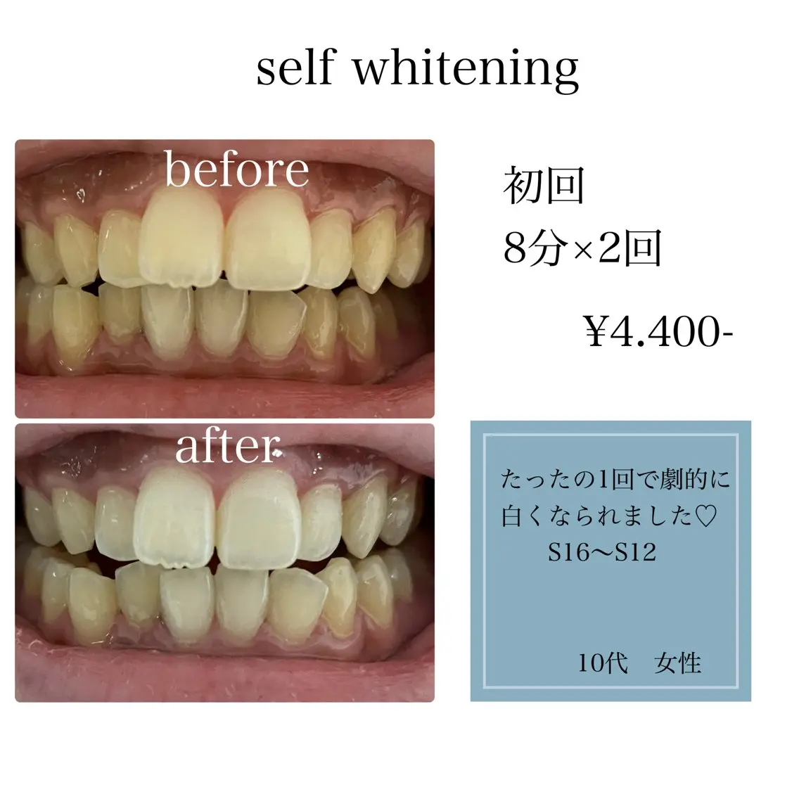 セルフホワイトニング8分×2回の写真