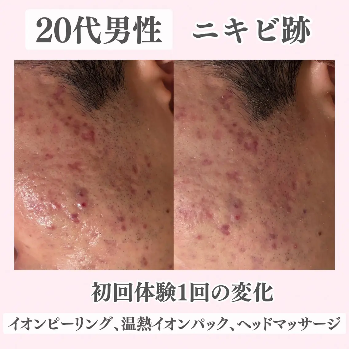 エステ リラク ニキビ・肌質改善専門 ♡人生が変わるサロンのエステ・リラクイメージ