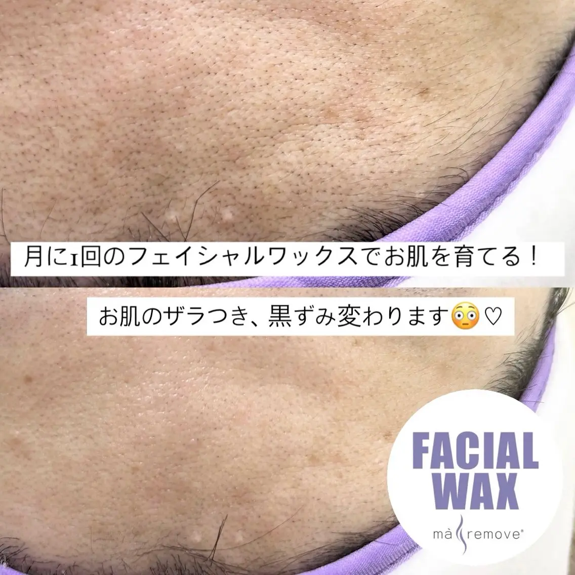 ‪【2回目までこの価格🪄】フェイシャルワックス脱毛🤍(注意事項必読⚠️)の写真