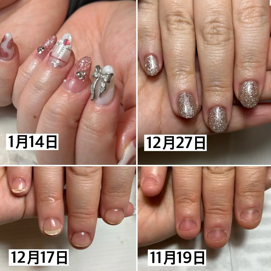 深爪矯正 再来のみの写真