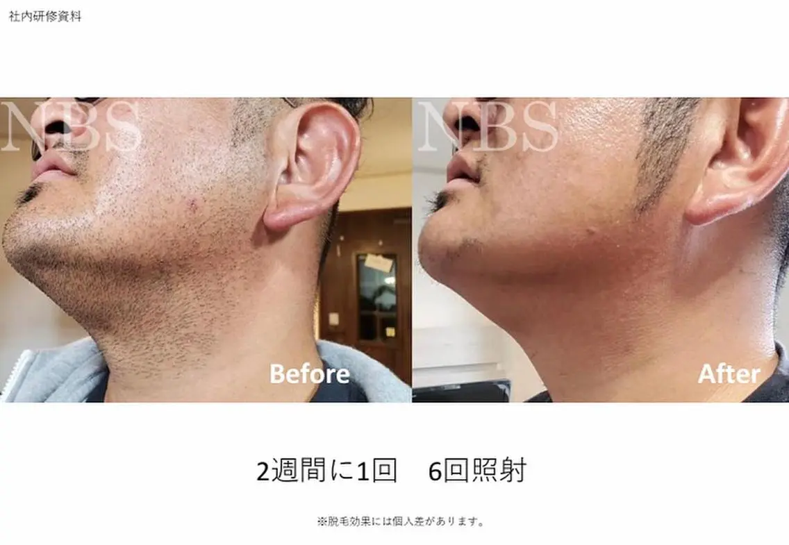 男性限定◎ ヒゲ全体 脱毛（あご・鼻下・頬・頬下の首・あご下の首）の写真