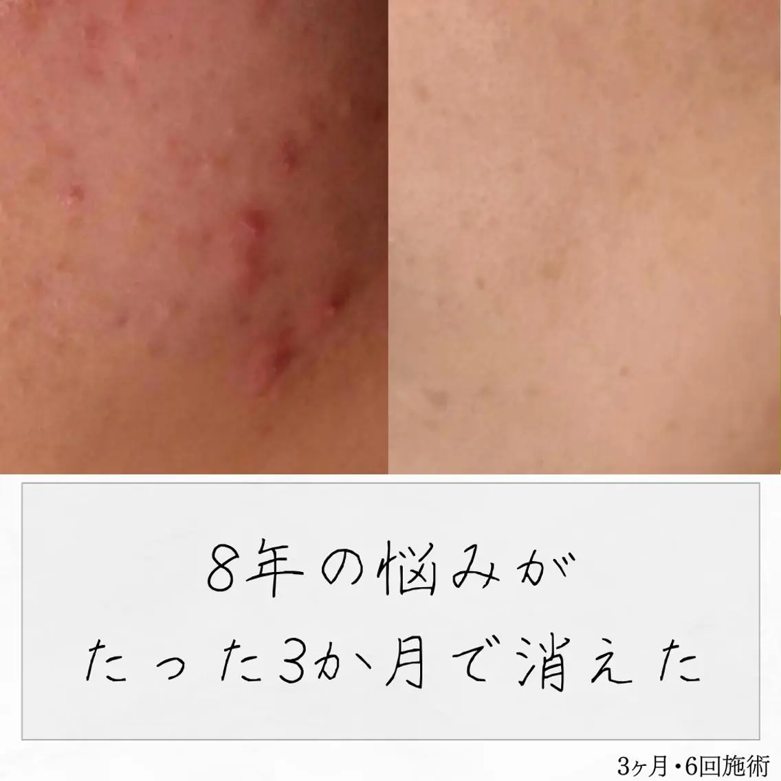 ニキビ経験者が施術 する専門サロン🌻のエステ・リラクイメージ