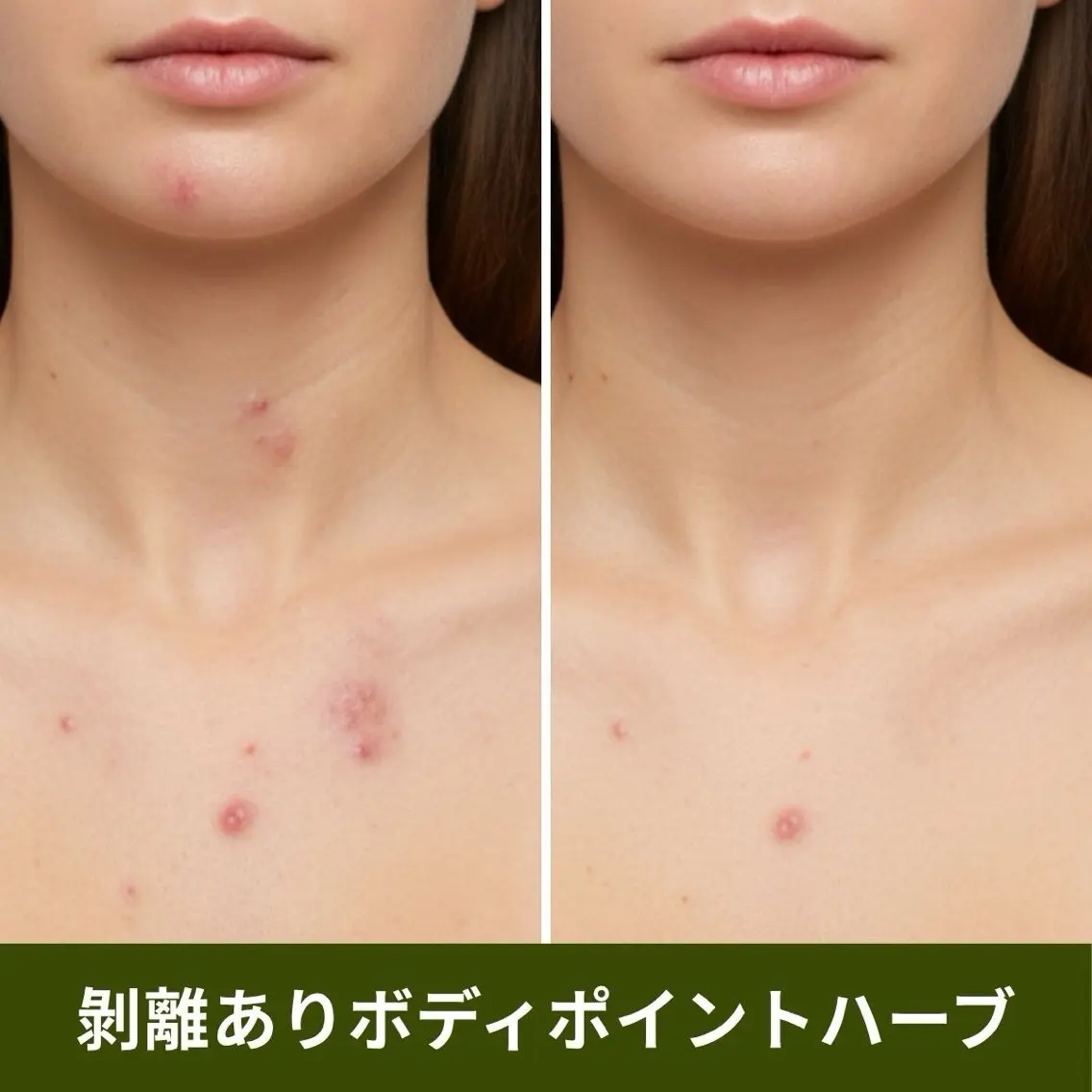 【ポイント施術】ボディハーブピーリング(剥離あり)ヒト幹細胞培養上清液入りハーブ🌿お尻/背中上or下/デコルテ/足/腕の写真