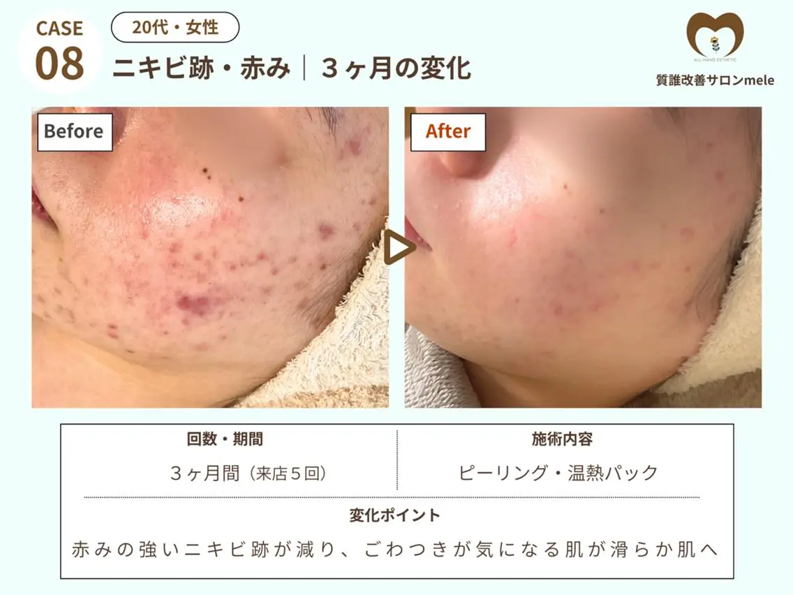 エステ リラク ニキビケア・毛穴専門 mele|もりぞののエステ・リラクイメージ