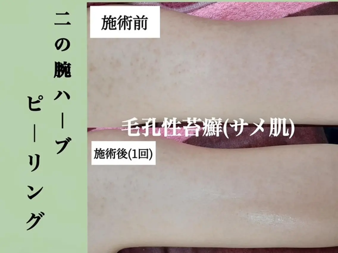 【二の腕ザラつき/肌育】二の腕ハーブピーリング×肌別パック/ブライダルや前撮りにも◎はく離無し※二の腕の裏面のみ施術の写真