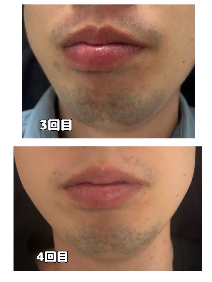 【青髭卒業！】ヒゲ脱毛 ¥4000の写真