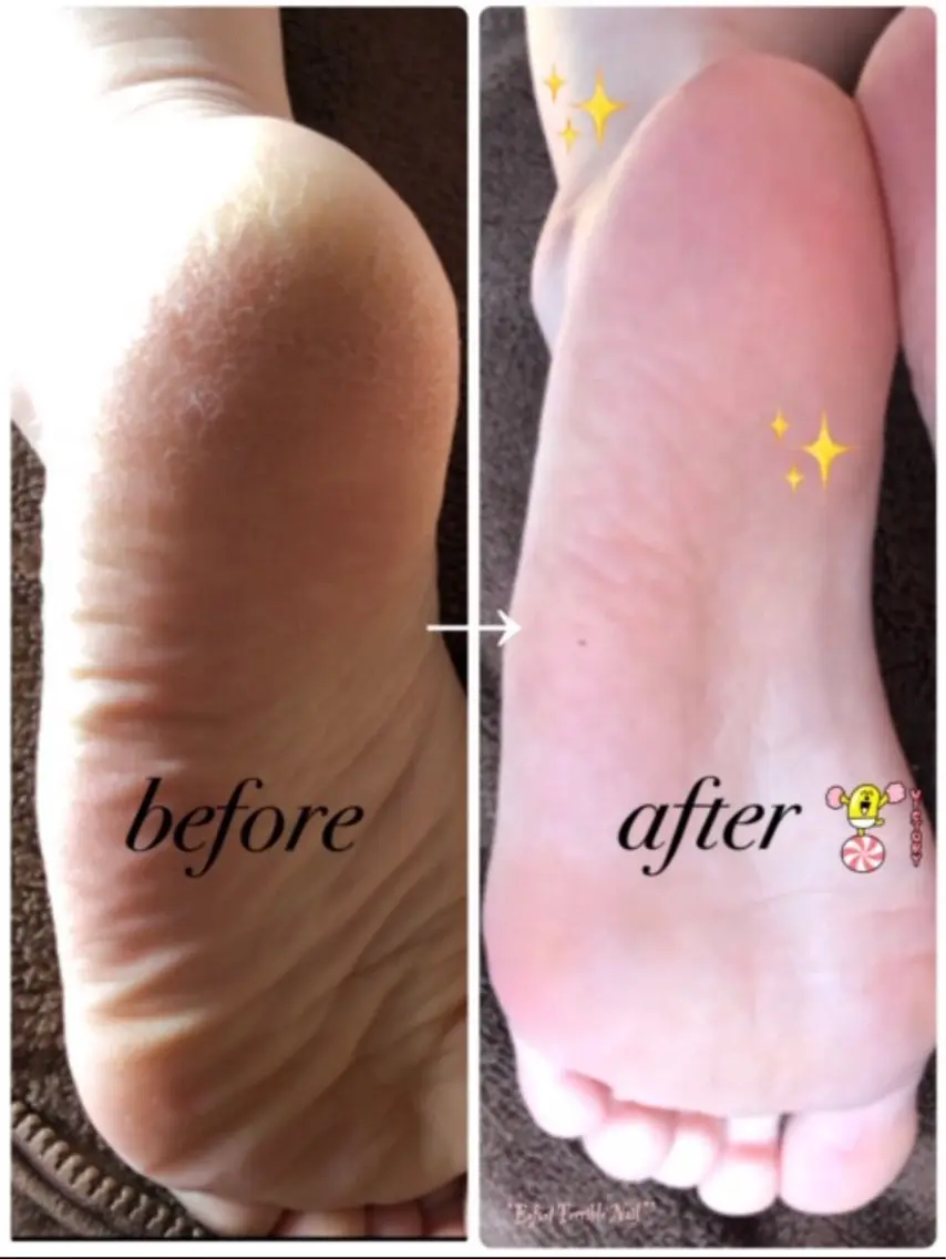 🌼フットメニュー⭐︎サンダルの季節到来👡カサカサかかとケア✨フットバス付角質除去と保湿ケアでかかとツルツルに🌟🌟の写真