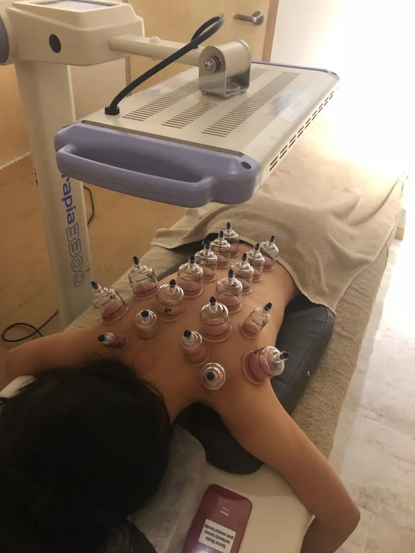 カッピング整体の写真