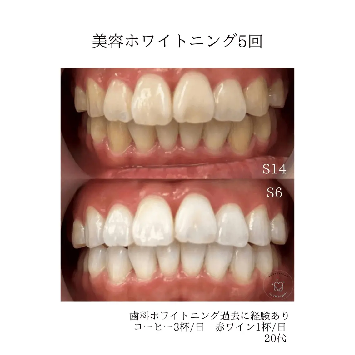 【初回お試し1.980円メニュー】美容ホワイトニング→不安な方向けの写真