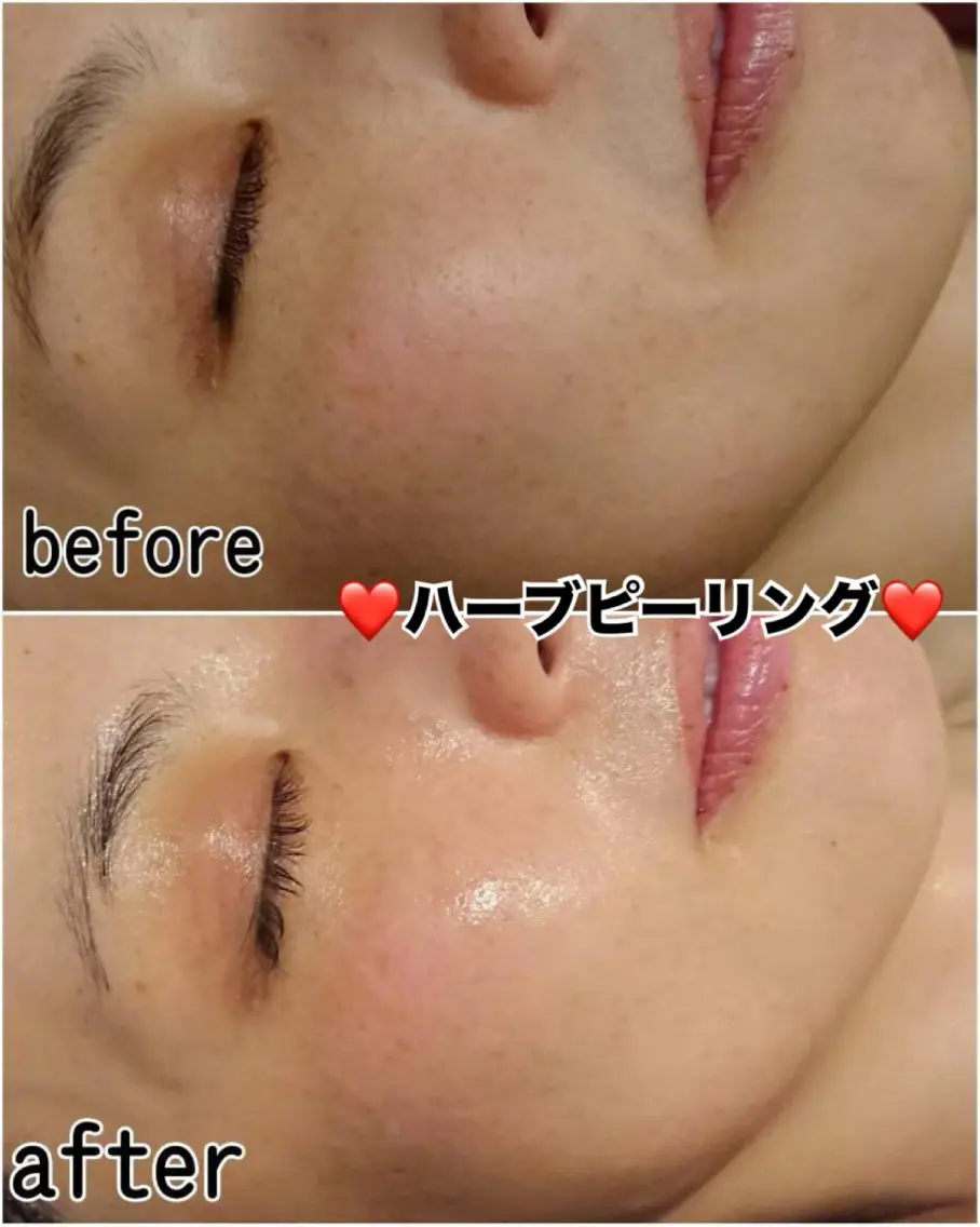エステ ハーブピーリング専門 毛穴洗浄❤️眉waxのエステ・リラクイメージ