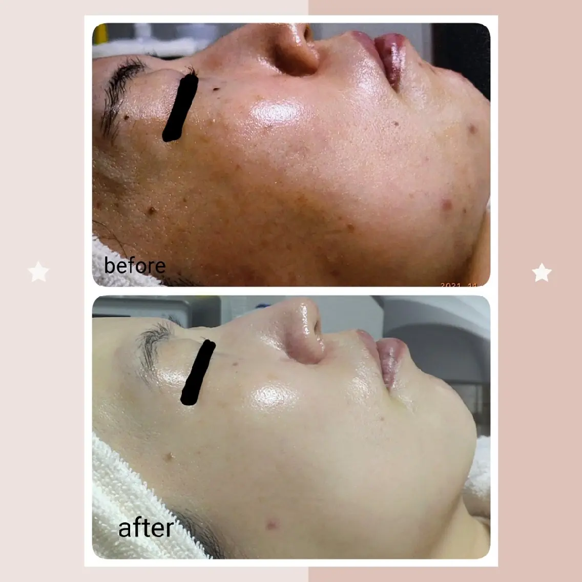 40歳以上の方に人気🈹毛穴開き➡️毛穴レスへ✨芸能人多数愛用🧡レチノール導入✨体験2回[京橋]の写真