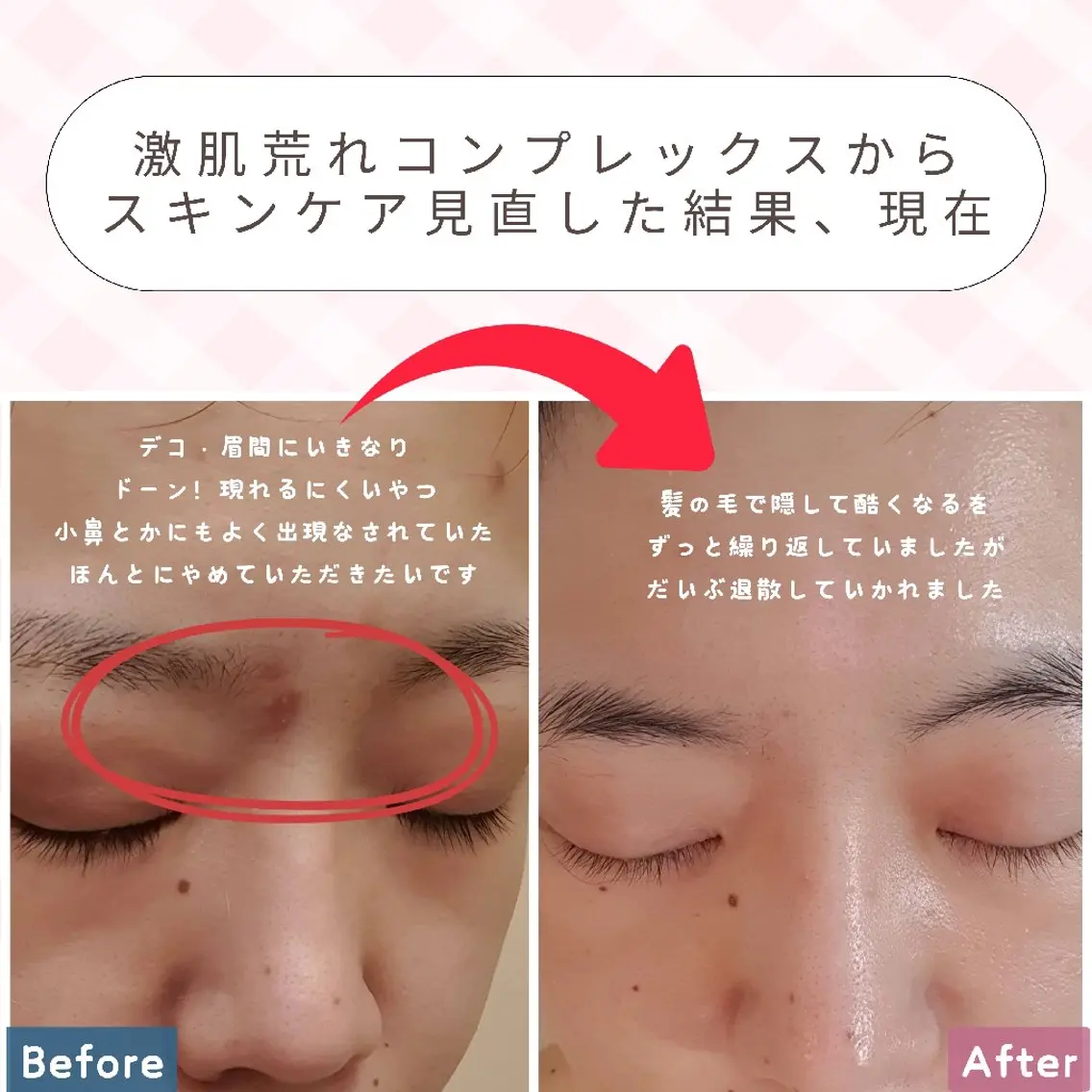 痩身ハーブピーリング 筋膜リリース☆B&Hのエステ・リラクイメージ