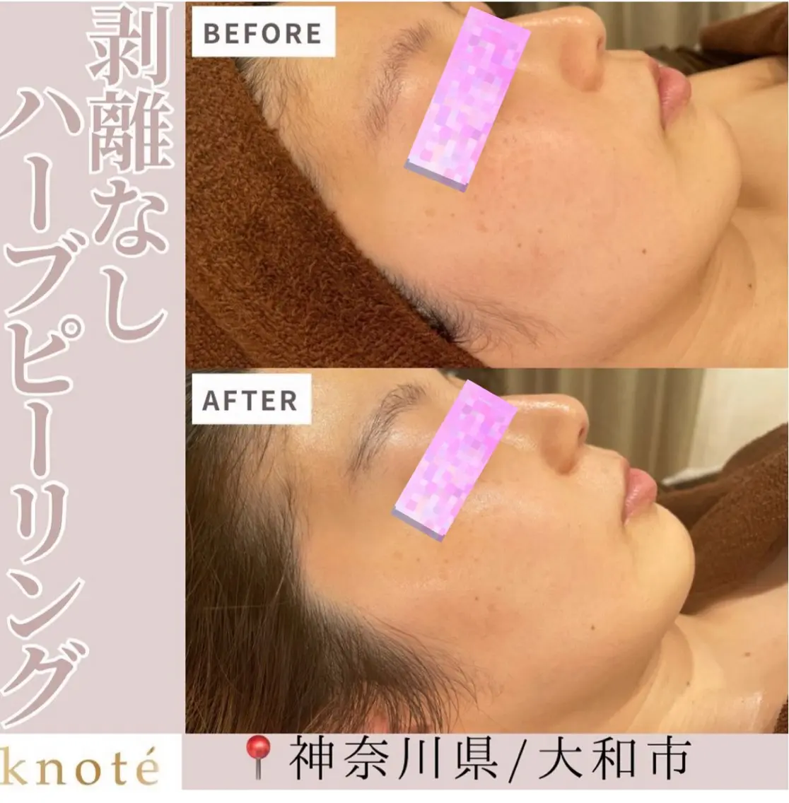 エステ knoté 🦋Nittaのその他イメージ