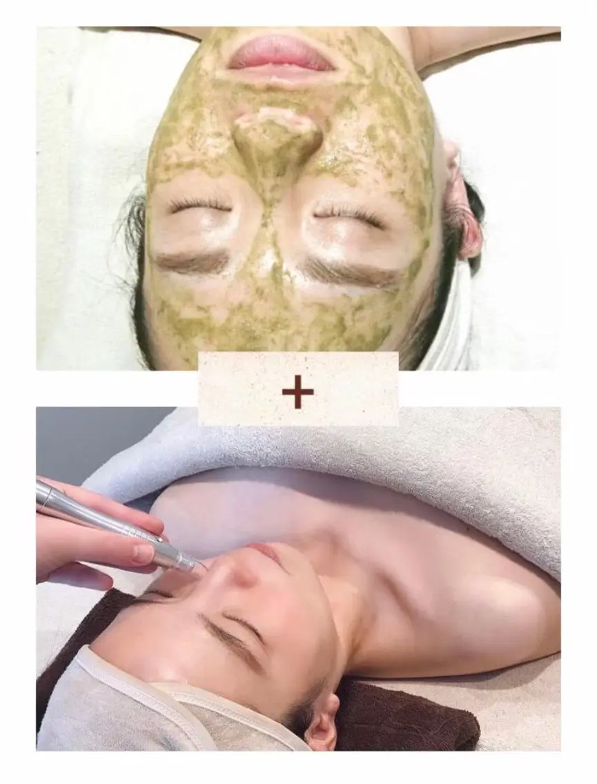 【ハーブピーリング+毛穴吸引】毛穴レス美肌✨(毛穴/ニキビ/ザラつき/シミ/シワ)の写真