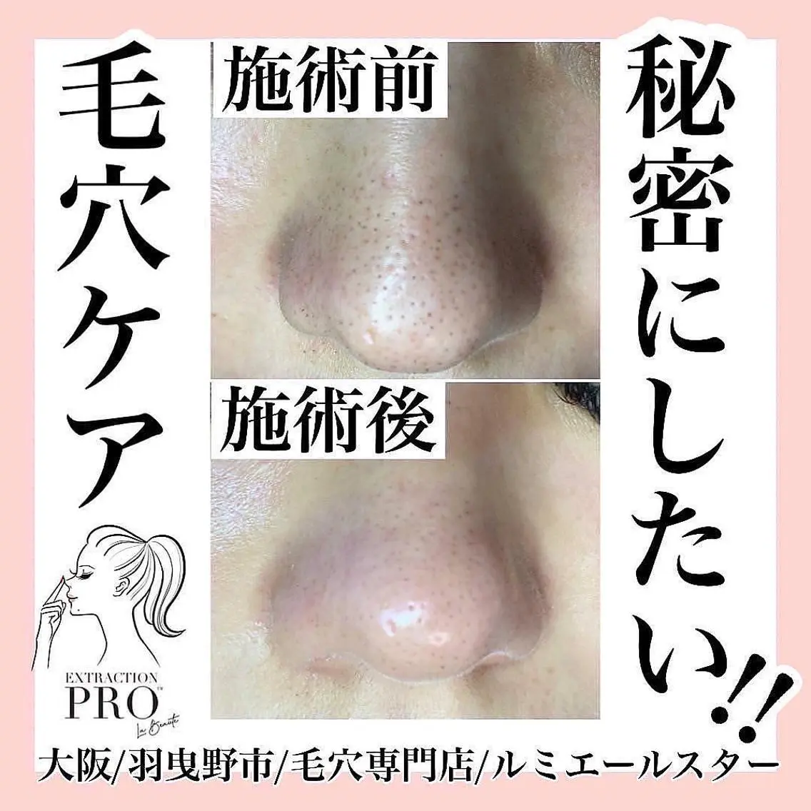エステ 最速 毛穴シミ改善 いくえのその他イメージ